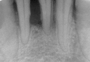 Periodontal Disease, showing 